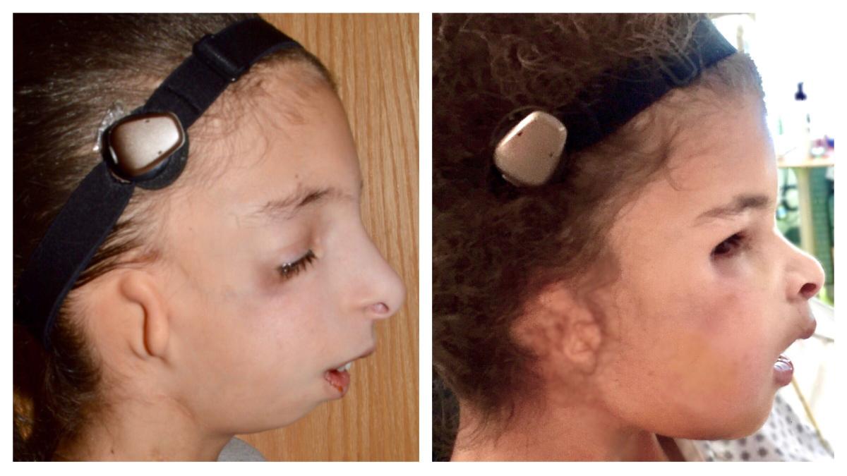 Craniofacial Treatment And Services | Dayton Children's